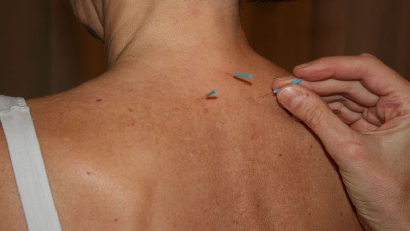 Akupunkturnadeln im Nackenbereich